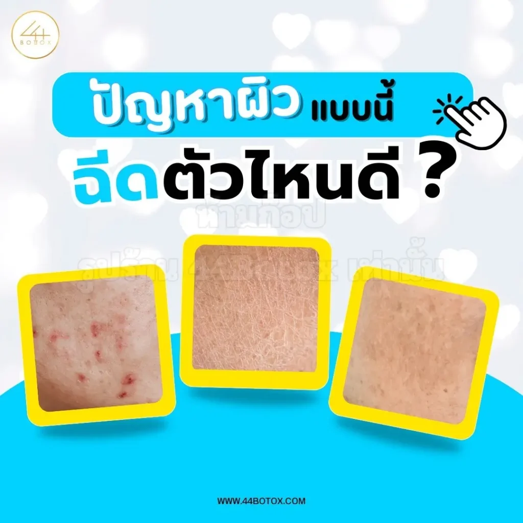 skin booster