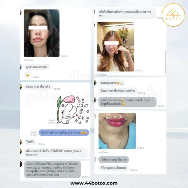 44 botox รีวิว