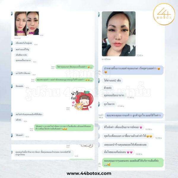 44 botox รีวิว