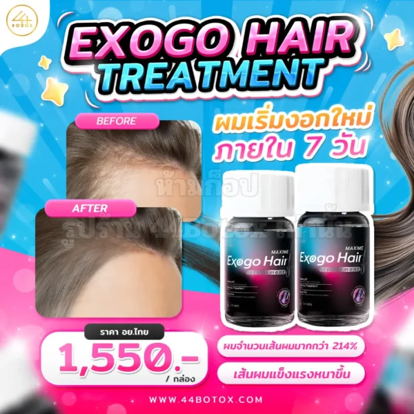 exogo hair treatment